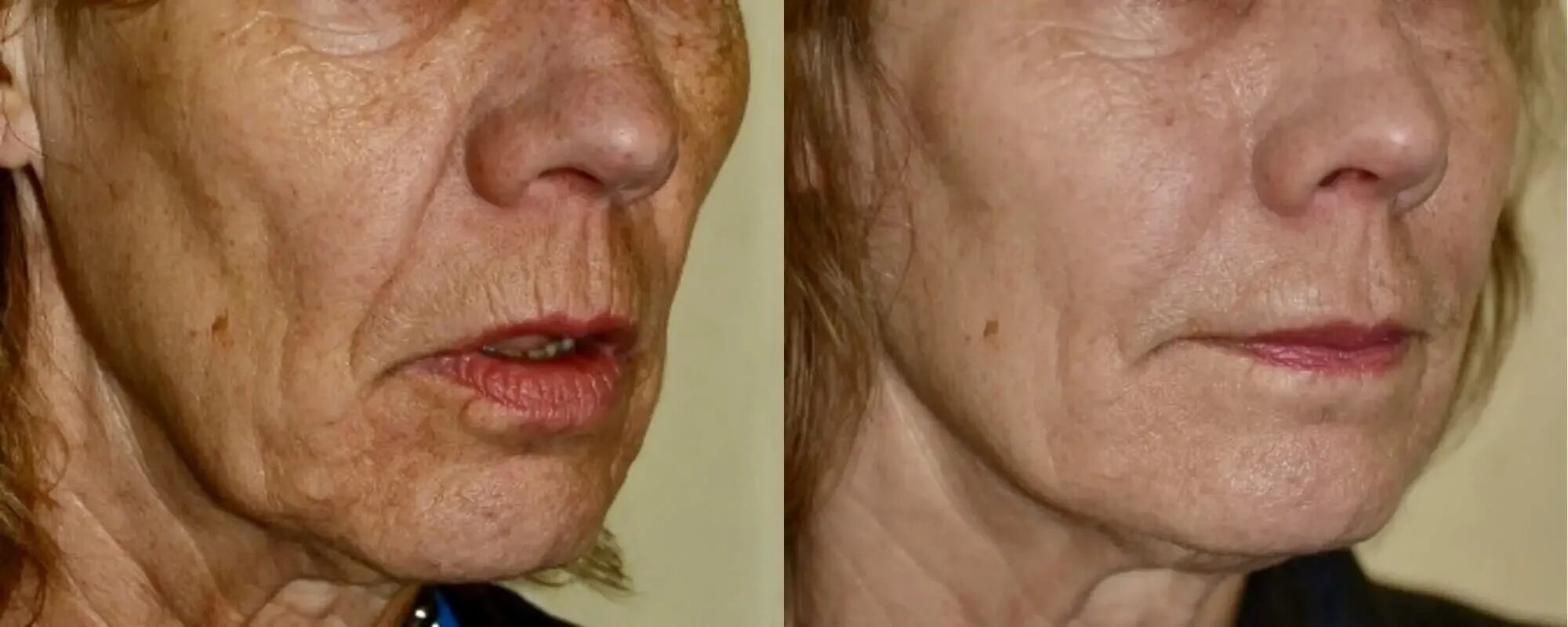Rejuvenation by Fillers